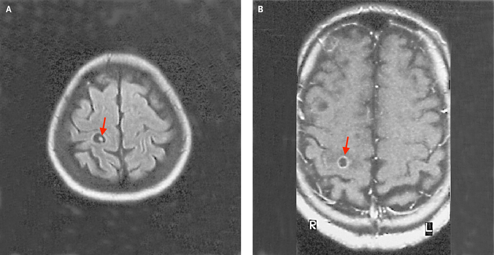 Parenchymal neurocysticercosis