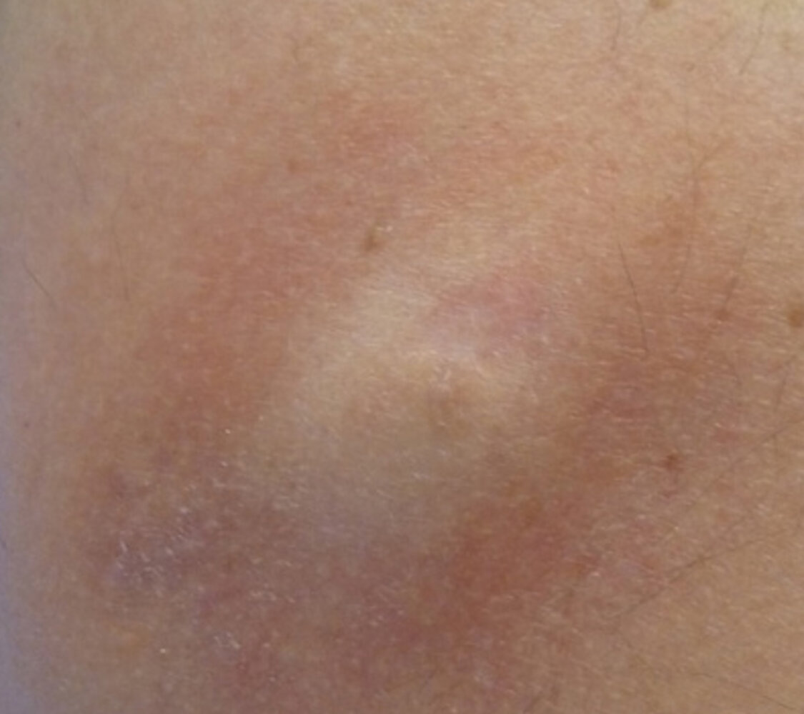Skin abscess