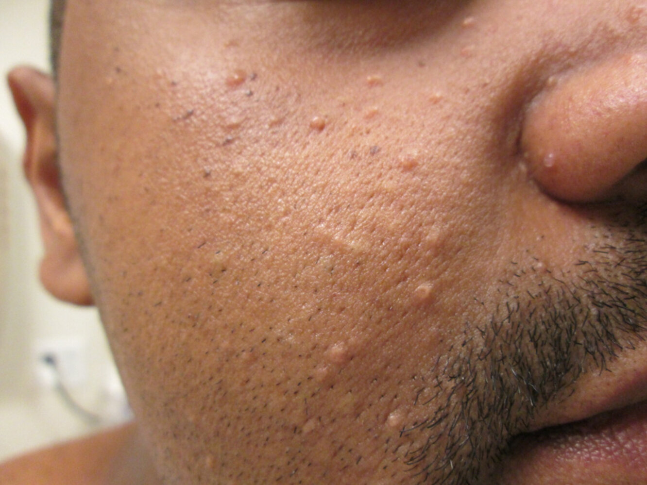 Molluscum contagiosum