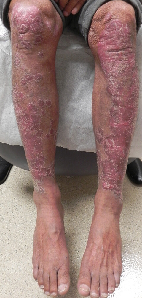 Psoriatic arthritis