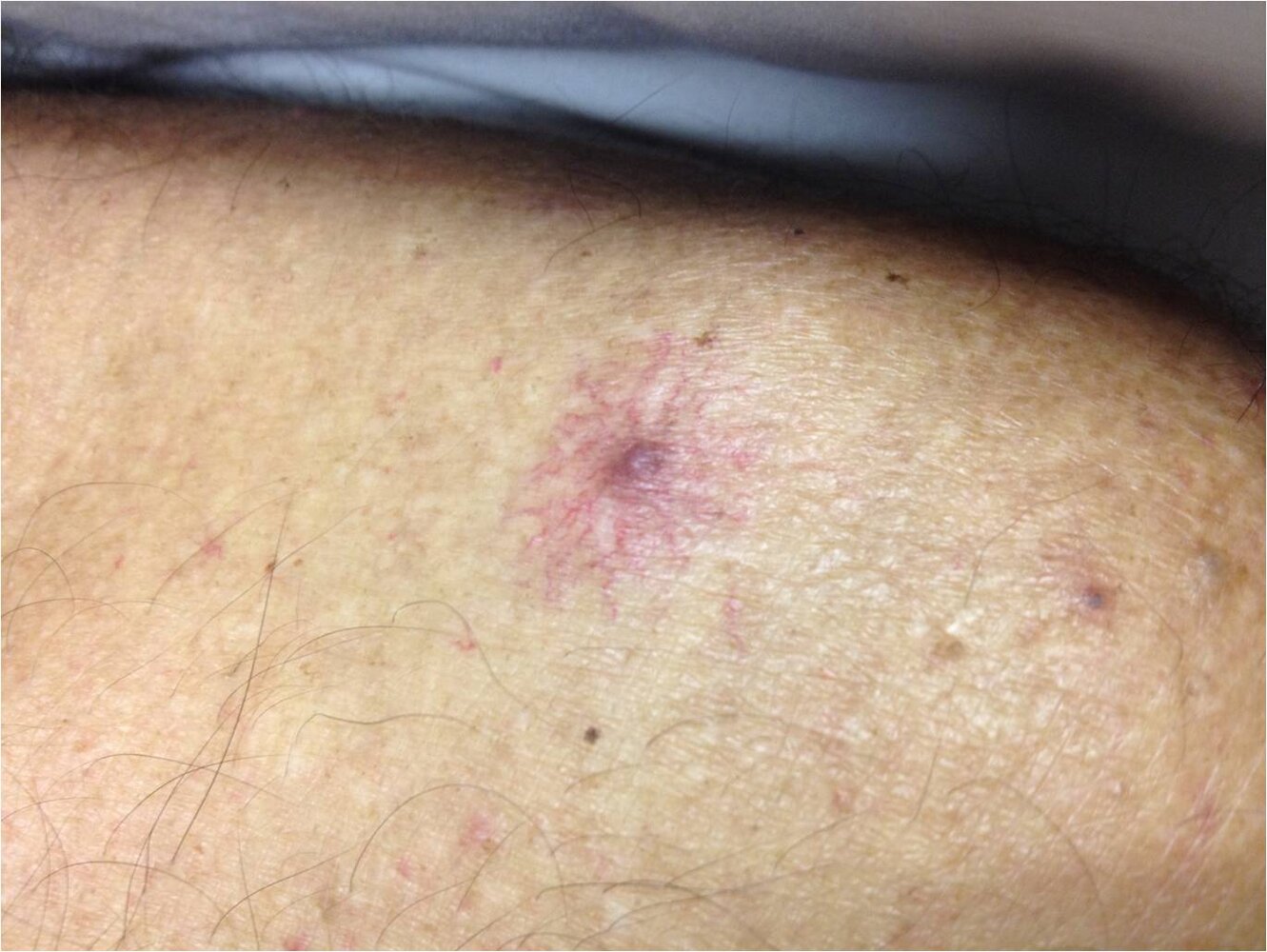 Spider angioma