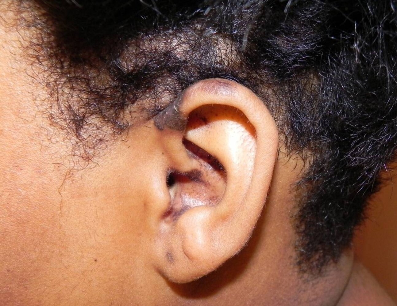 Alopecia in discoid lupus erythematosus