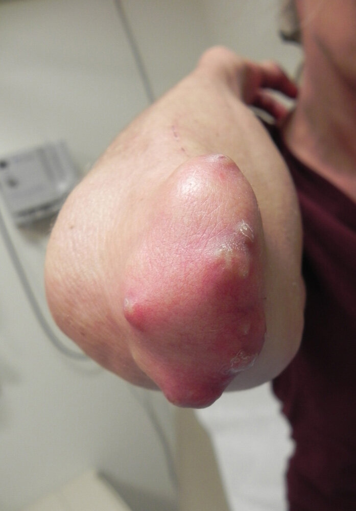 Rheumatoid nodules