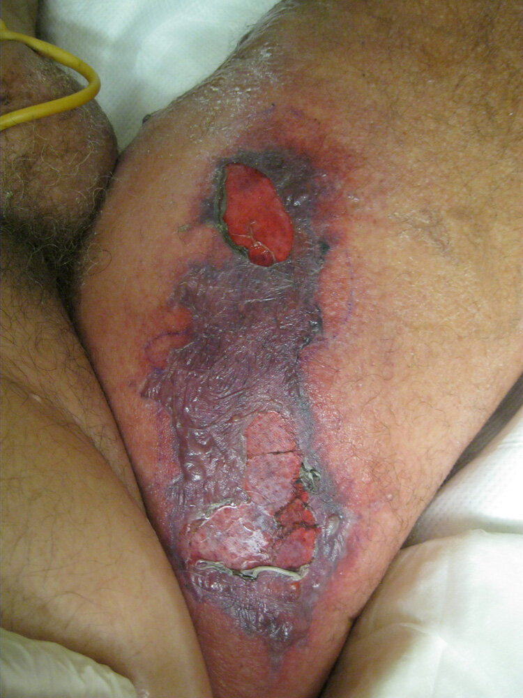 Ecthyma gangrenosum