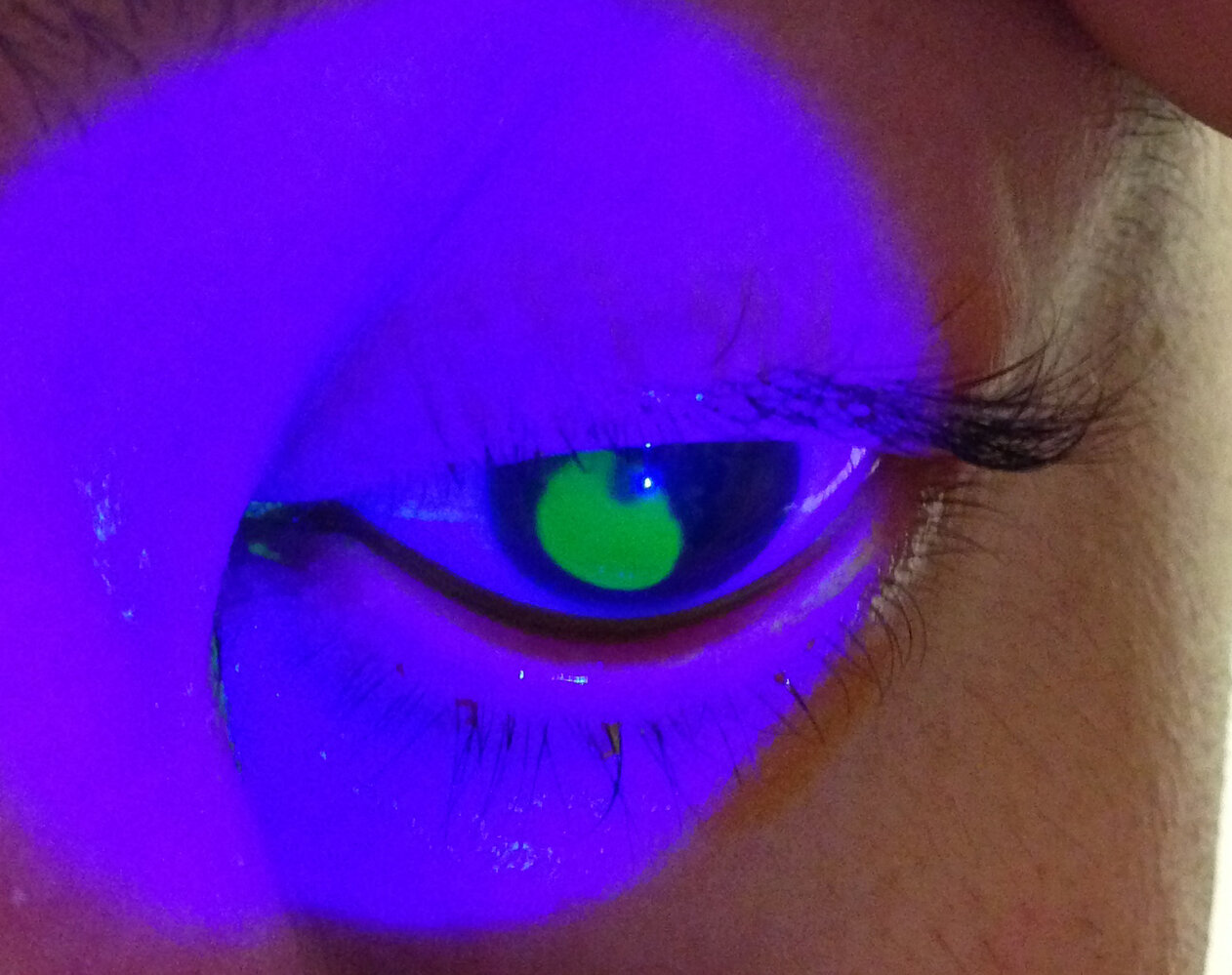 Corneal abrasion