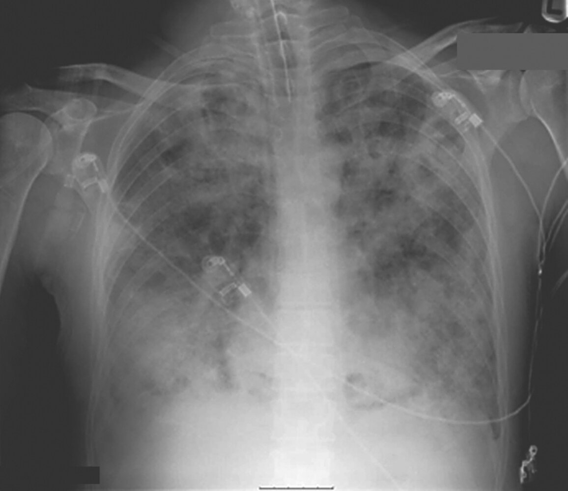 Opacities in setting of ARDS