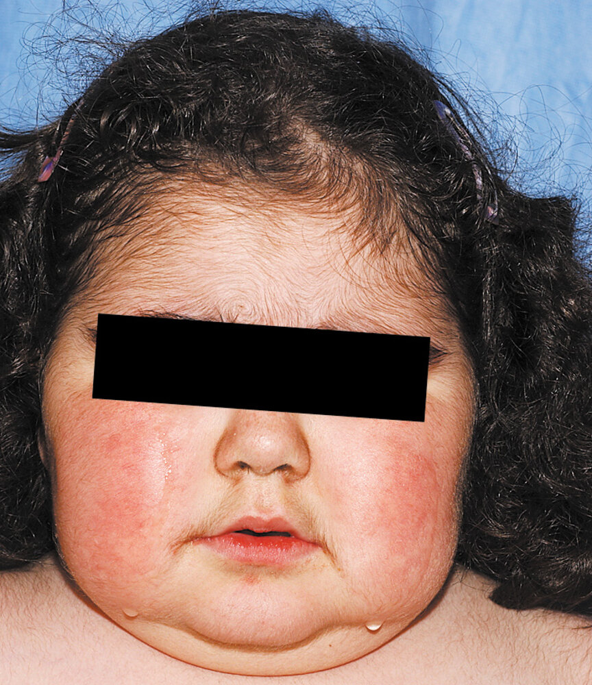 Cushing syndrome