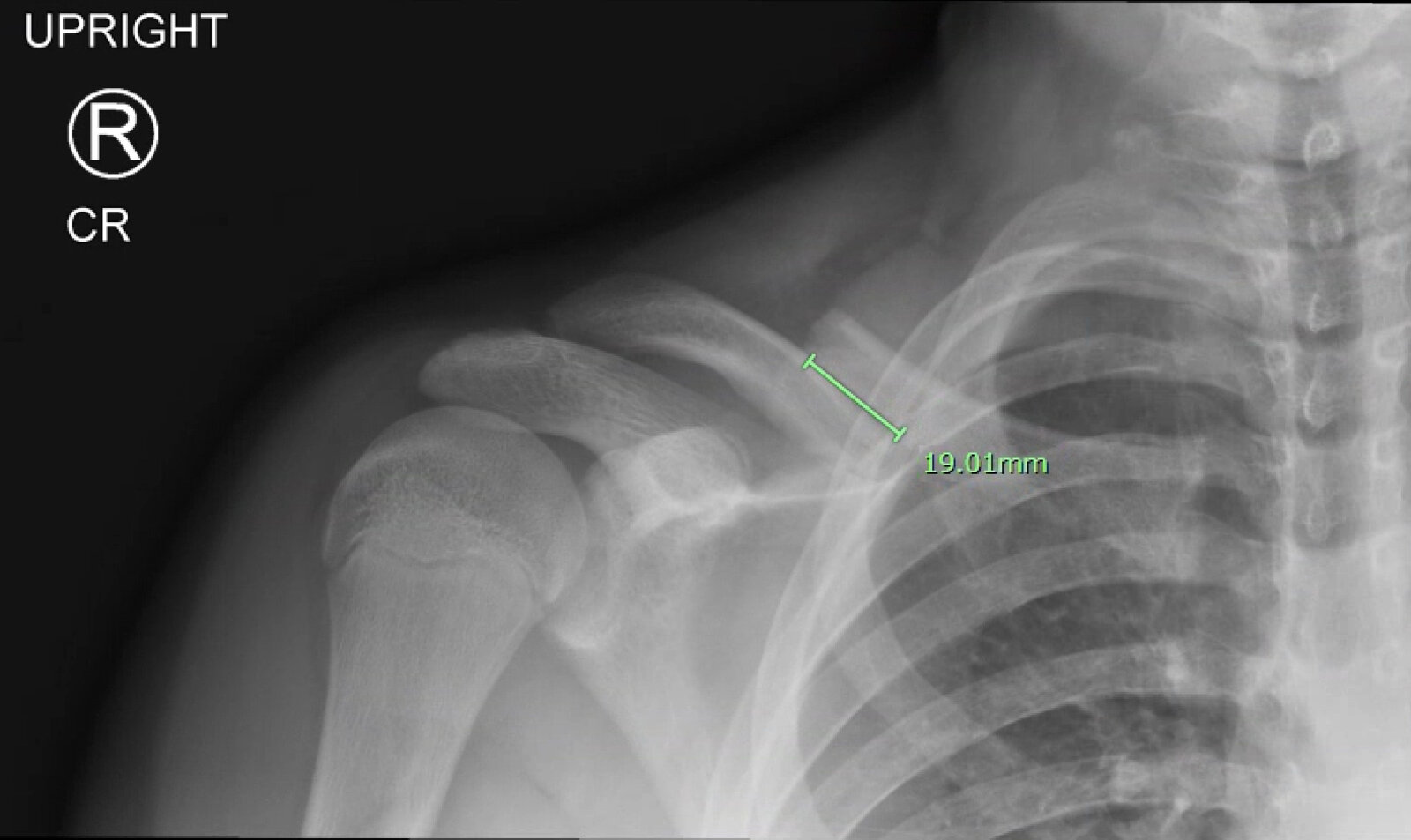 Midshaft clavicle fracture