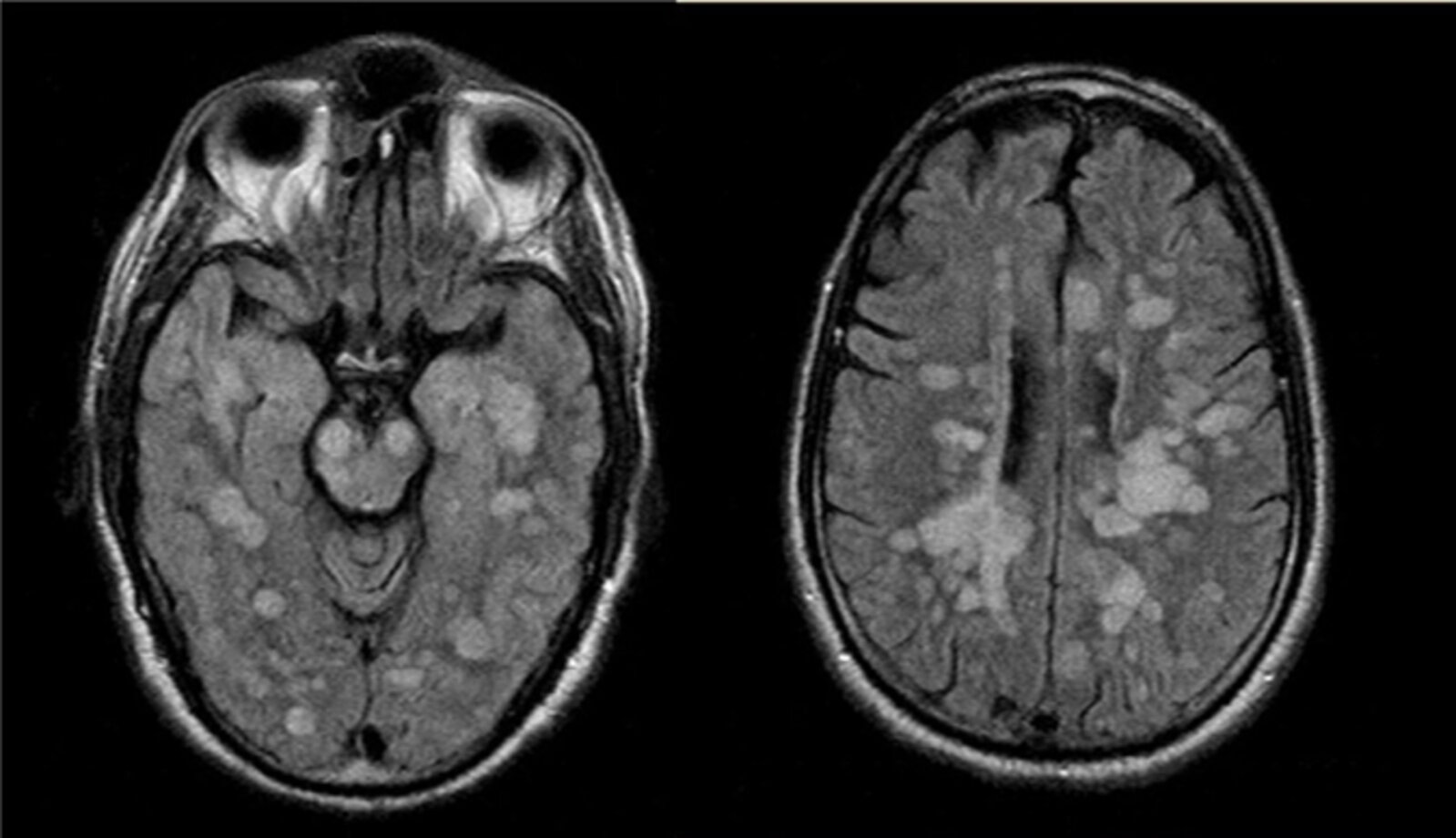 Acute disseminated encephalomyelitis