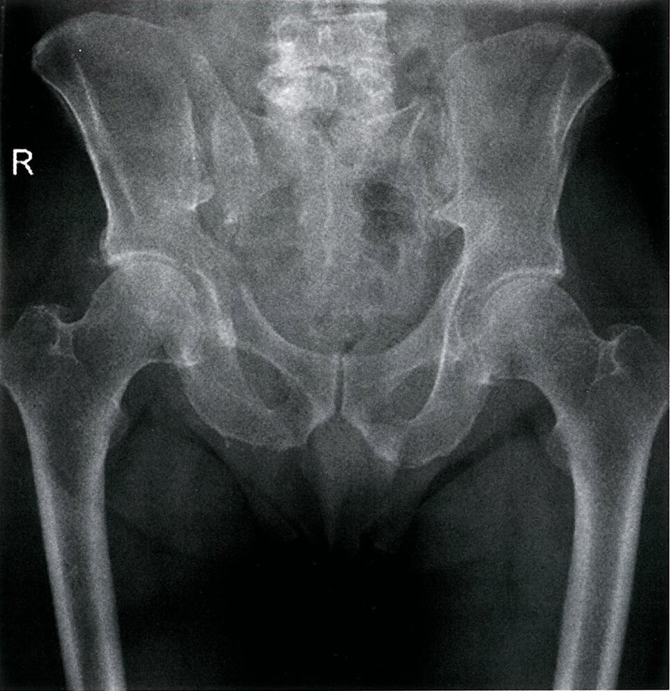 Posterior pelvic ring disruption and right pubis fracture