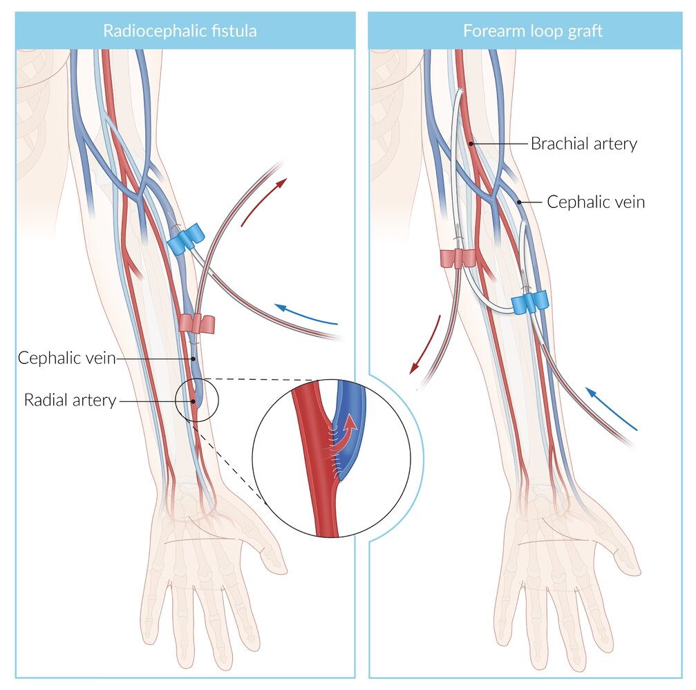 Hemodialysis cannulation