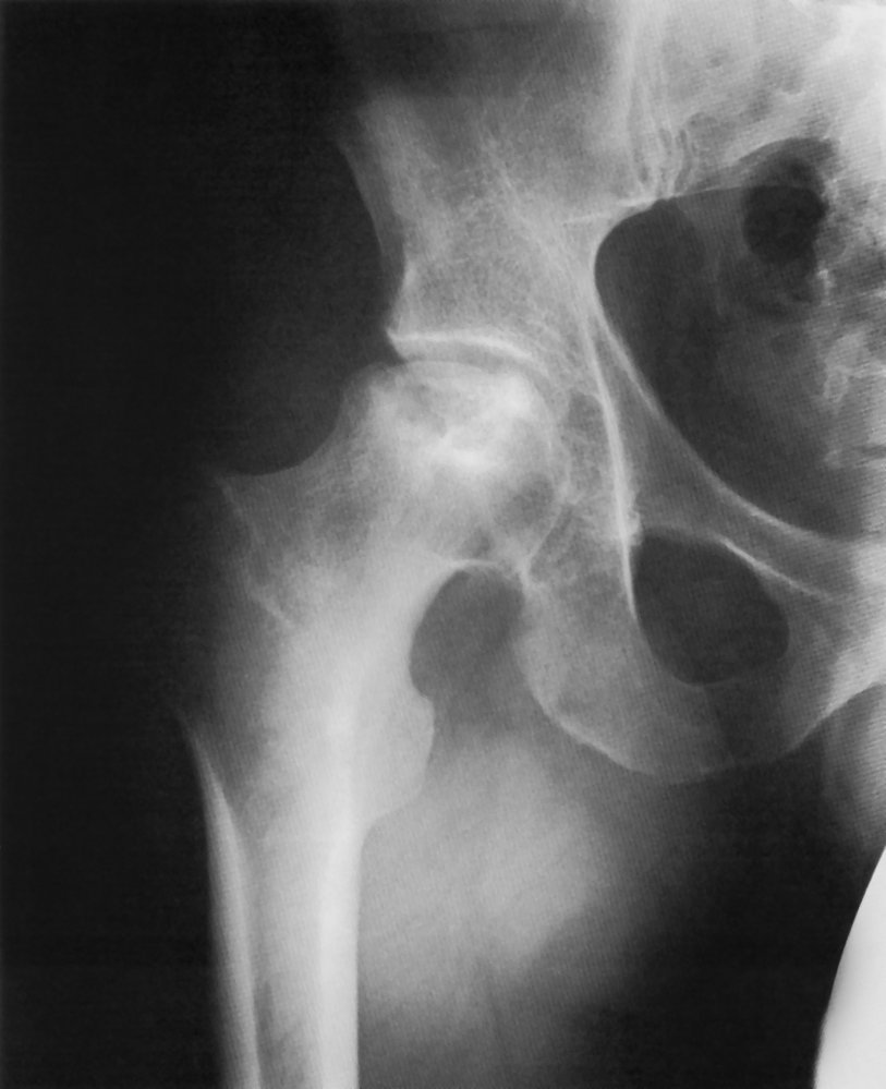 Osteonecrosis of the femoral head