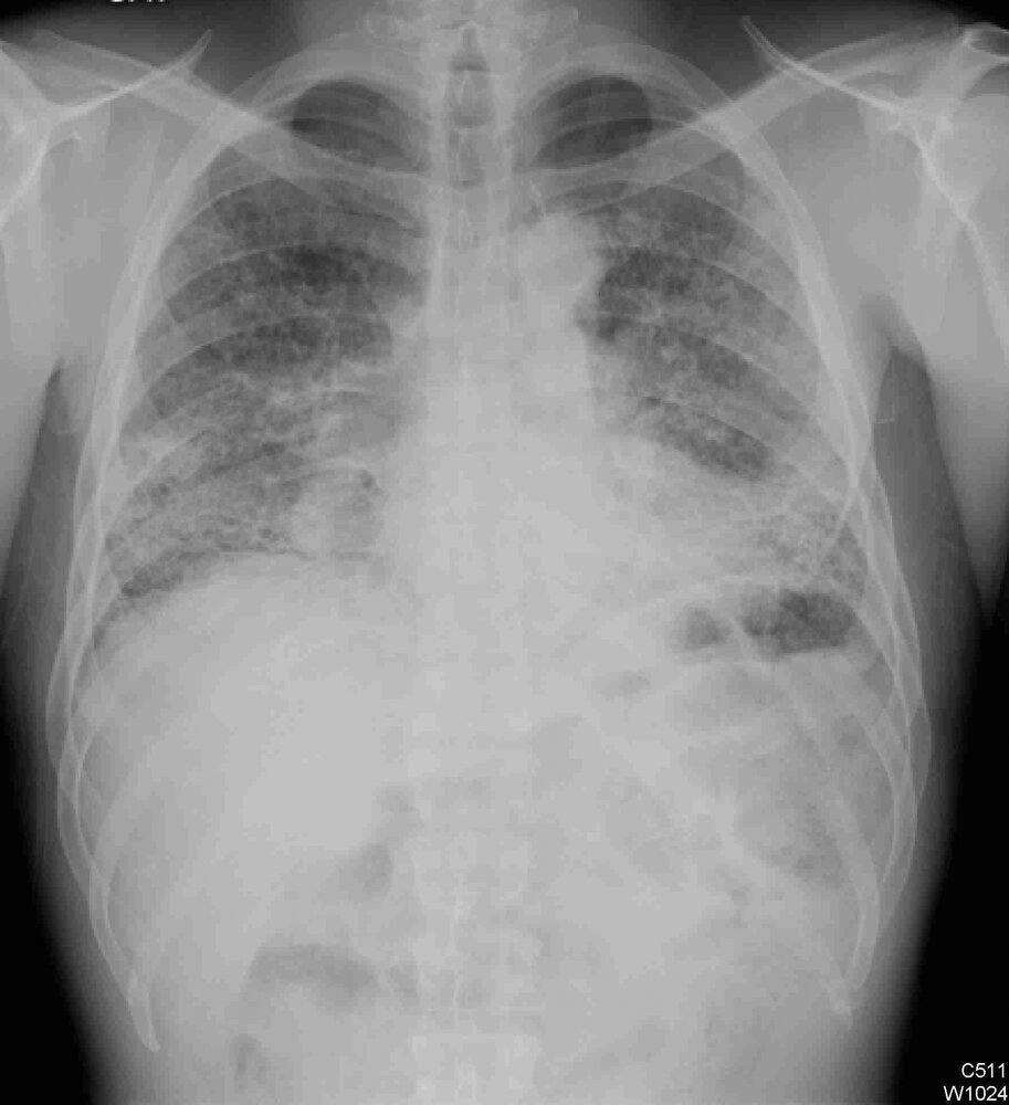 Interstitial lung disease