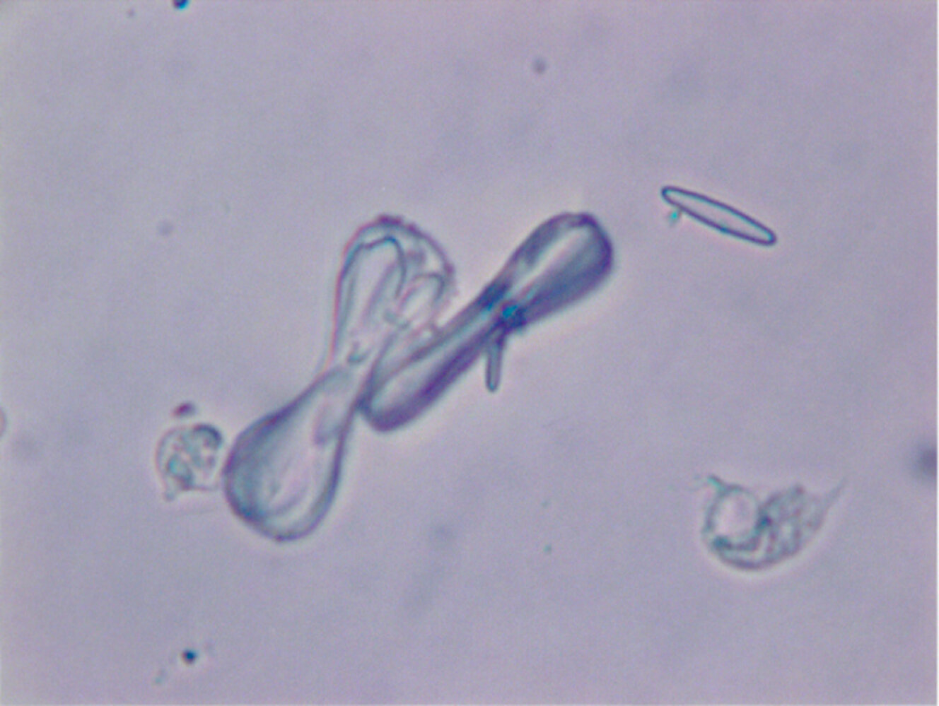 Calcium oxalate crystals in urine