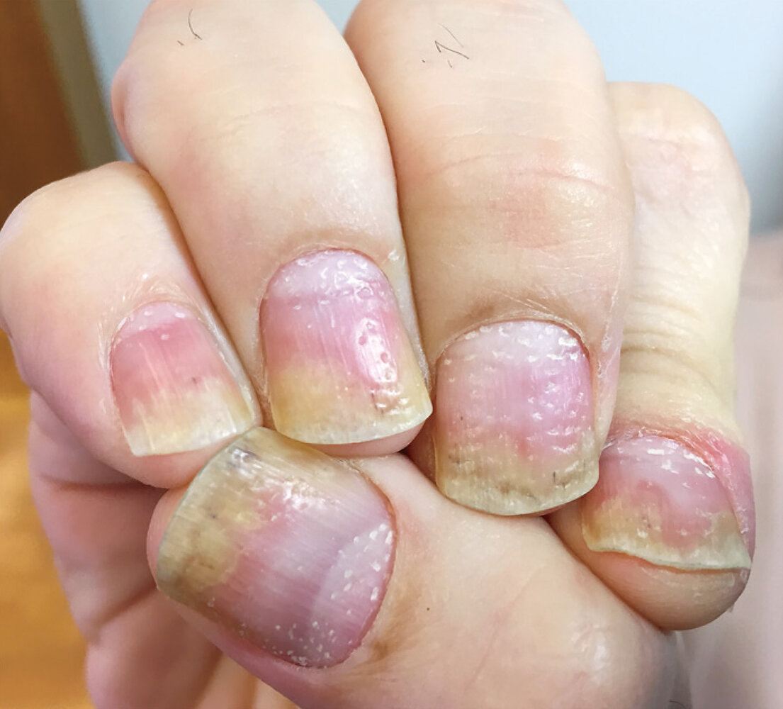 Nail pitting and onycholysis