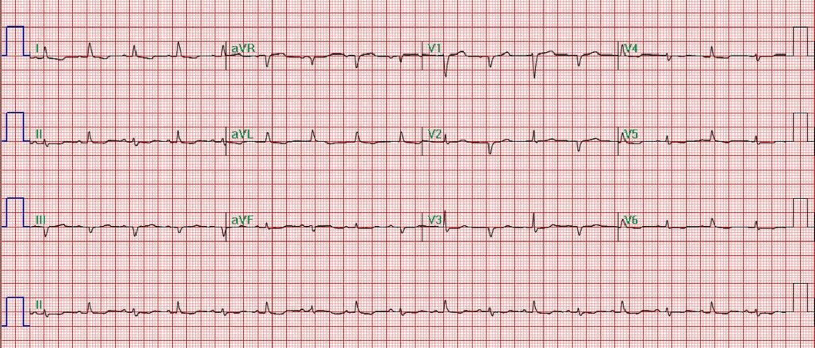 Electrical alternans