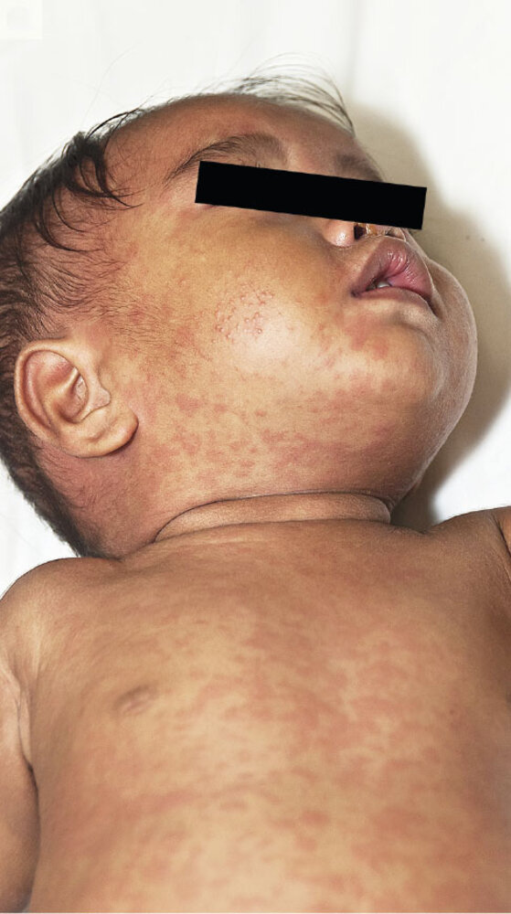 Measles rash