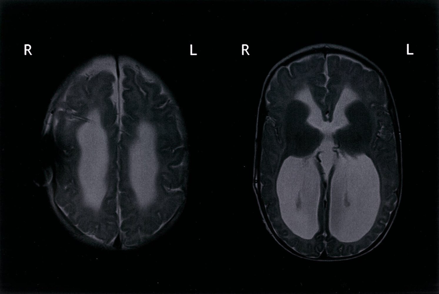 Hydrocephalus with a cerebral shunt in-situ