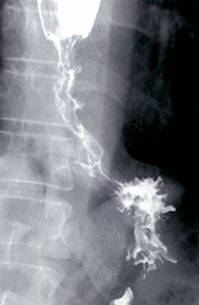Distal esophageal stricture from carcinoma