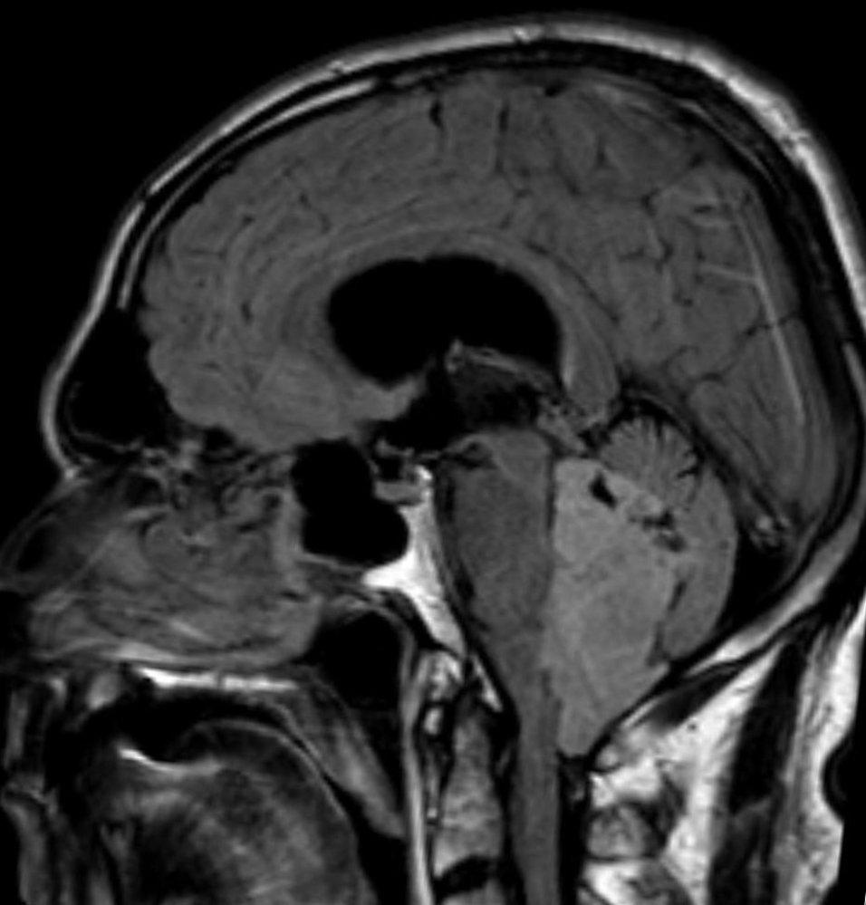 Ependymoma