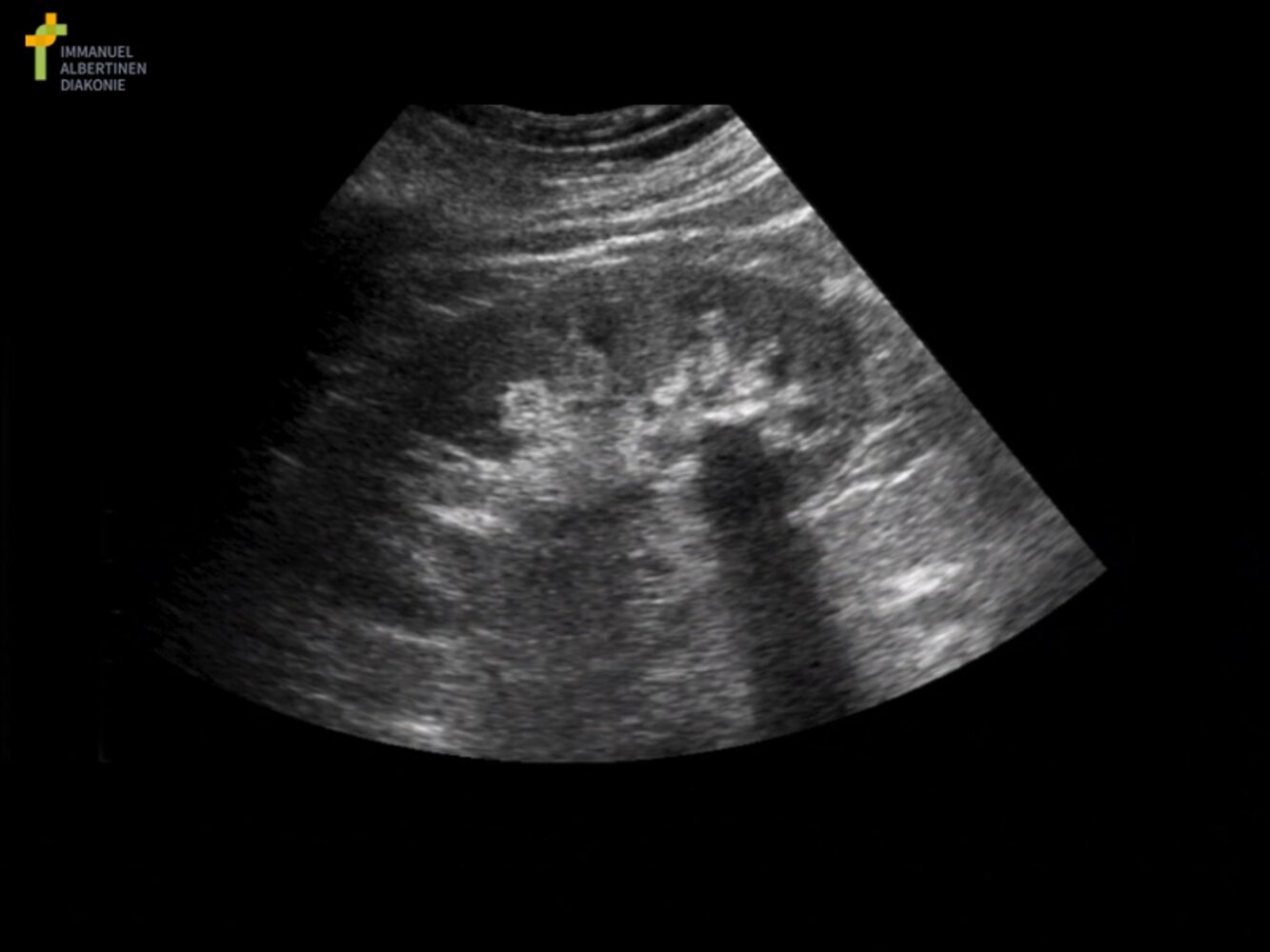 Nephrolithiasis