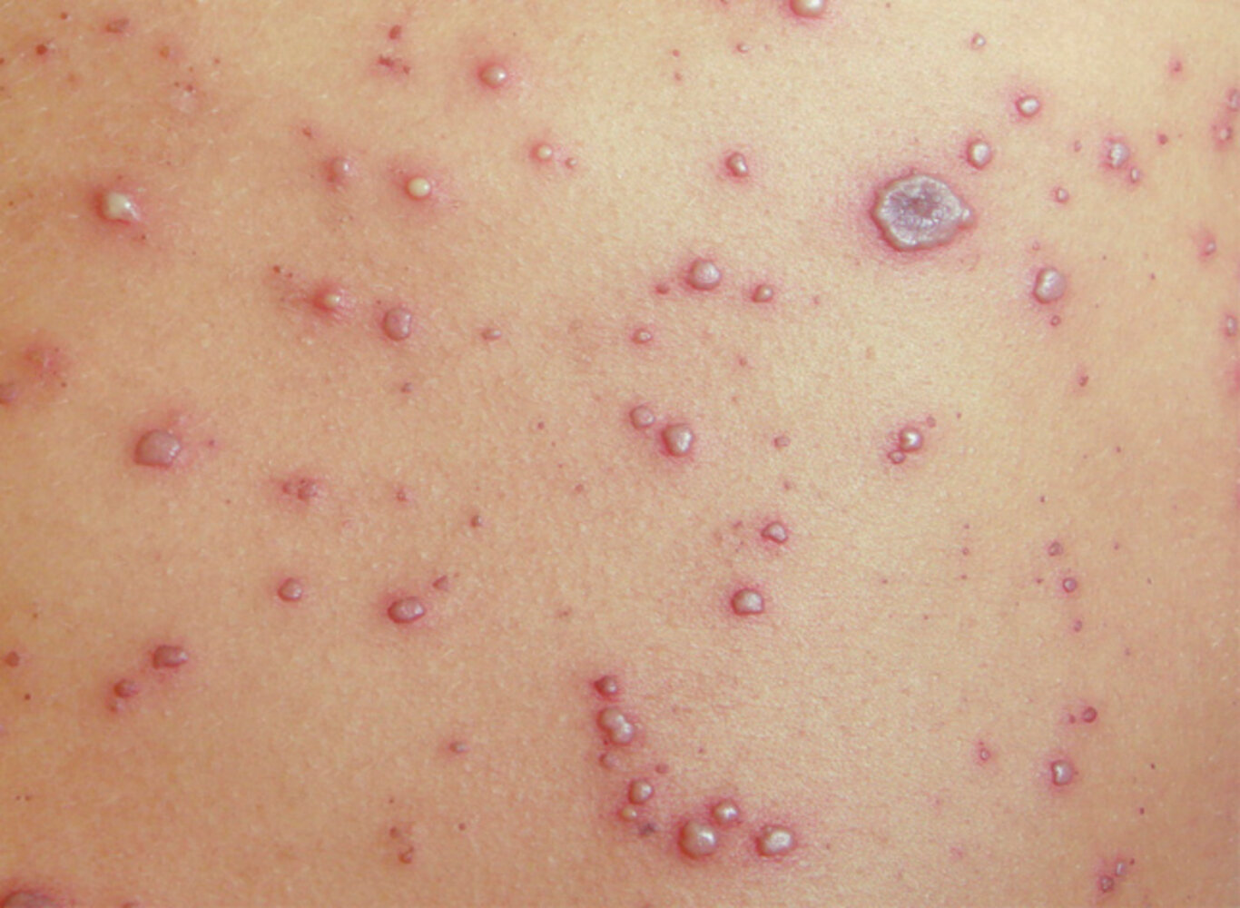 Varicella