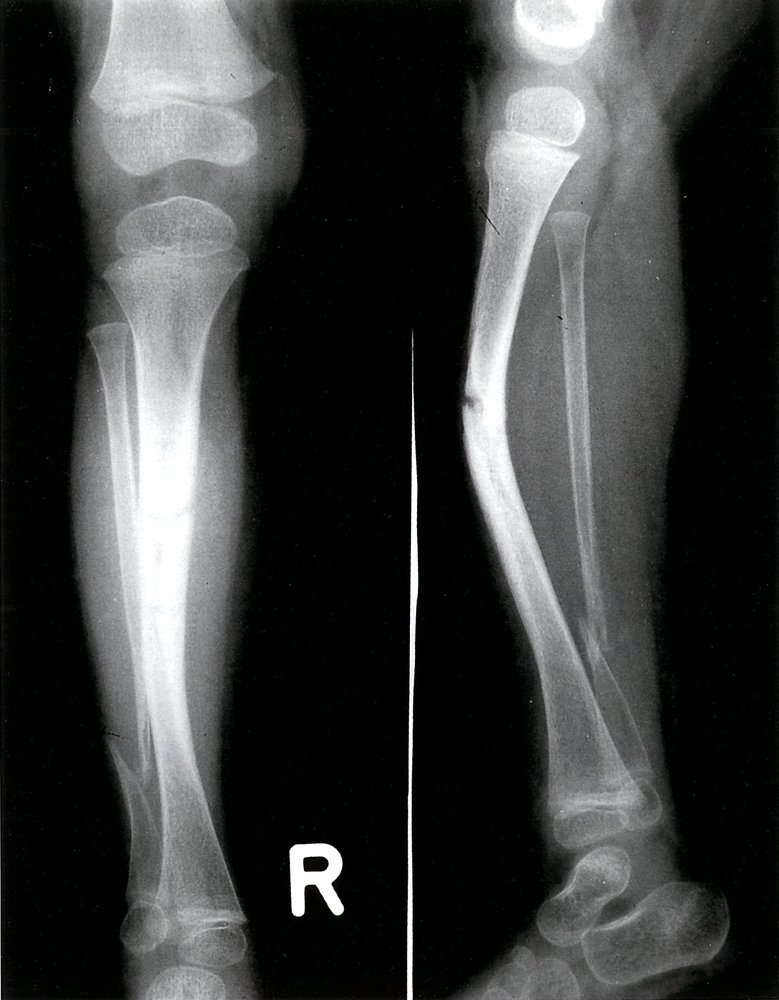 Congenital pseudoarthrosis of the tibia
