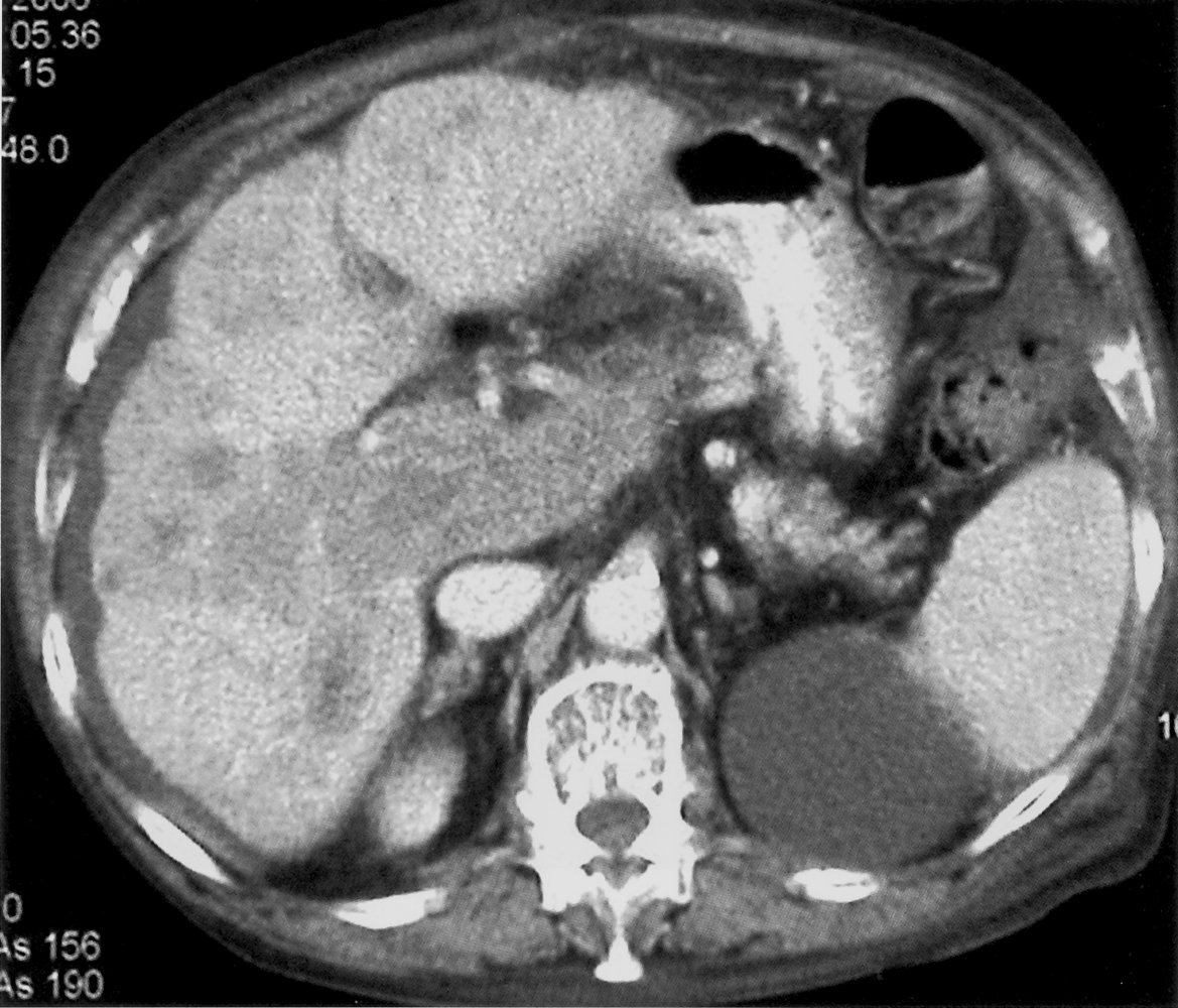Hepatocellular carcinoma in cirrhotic liver