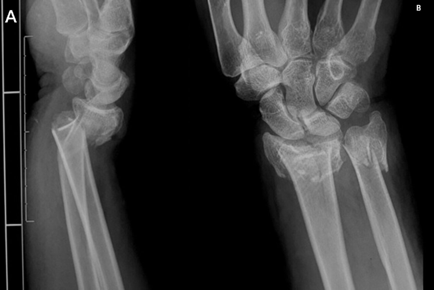 Comminuted fractures of the distal radius and ulna