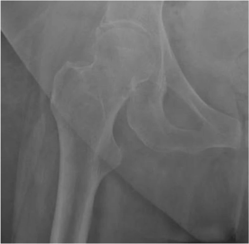 Femoral neck fracture