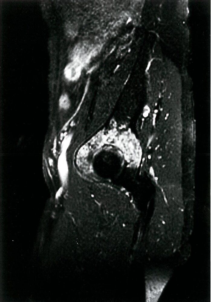 Enhancing acetabular mass