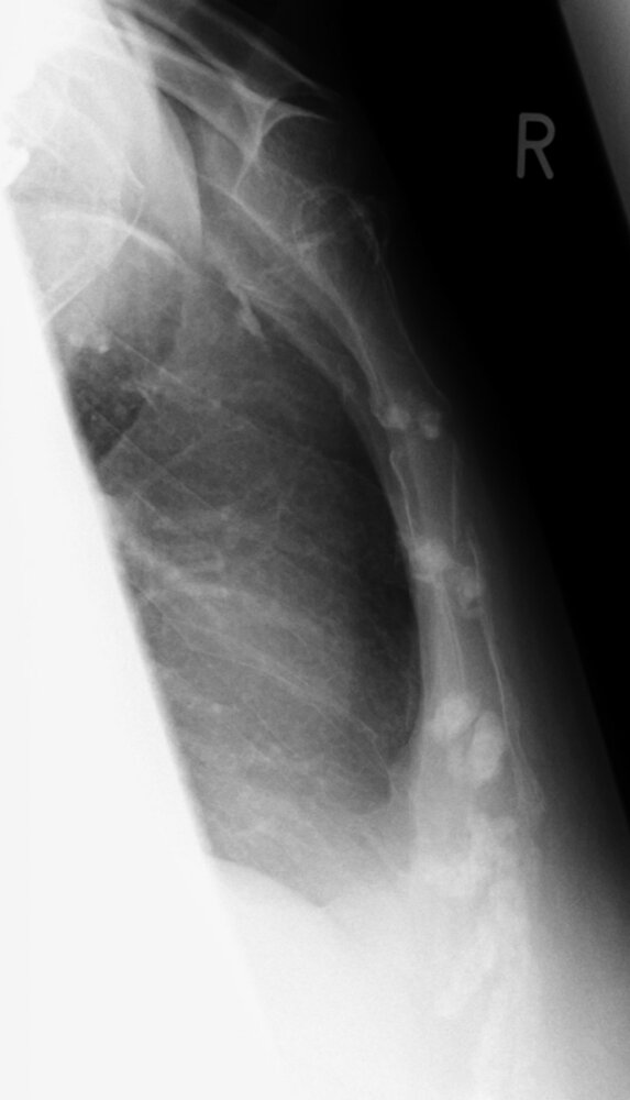 Sternal fracture