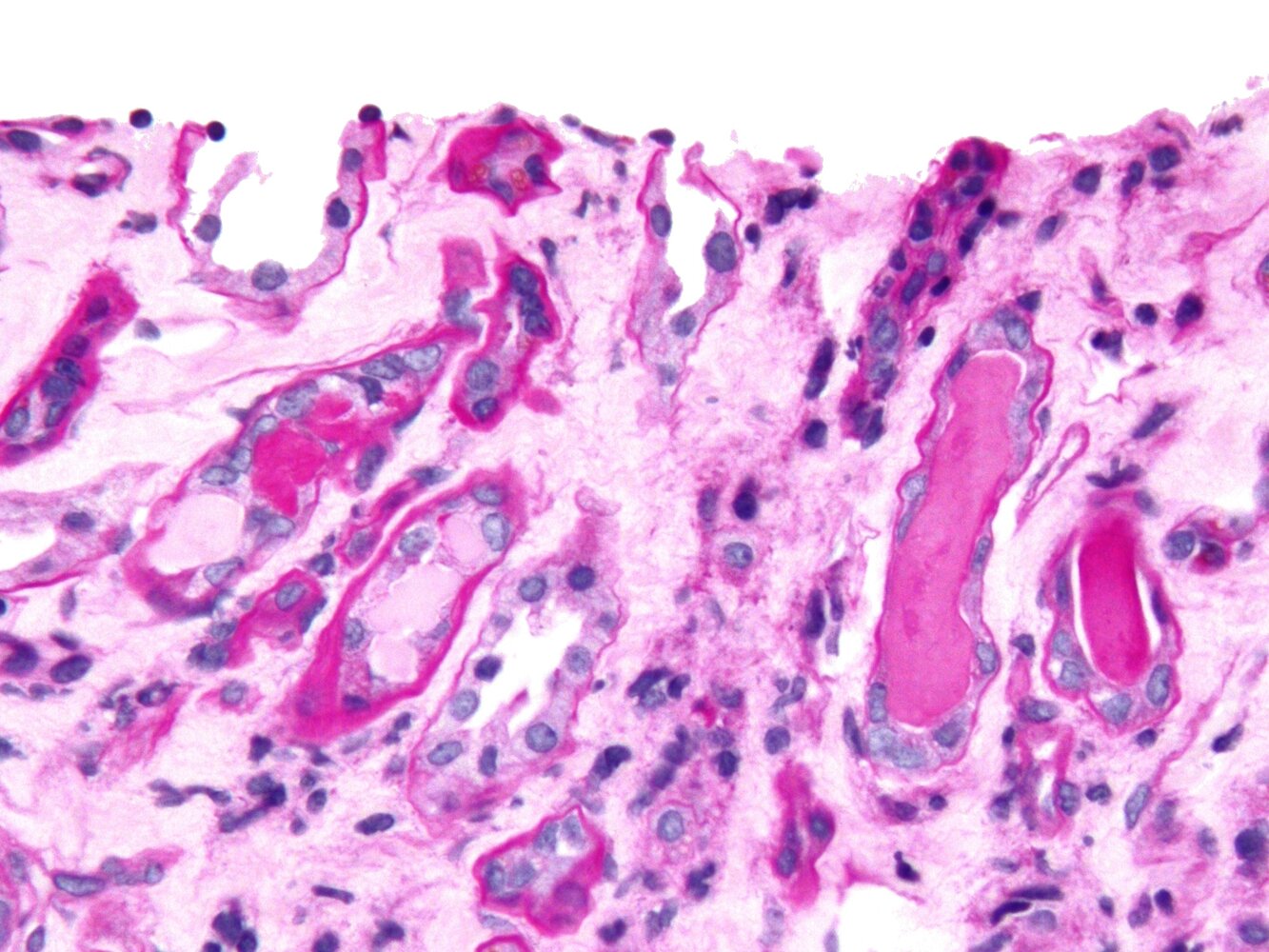 Myeloma cast nephropathy