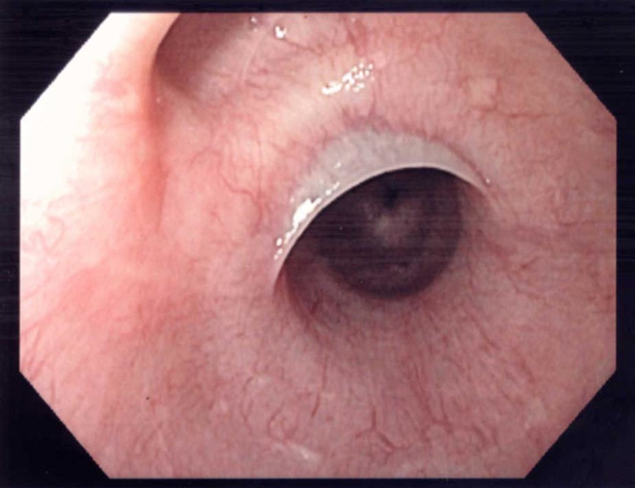 Esophageal web
