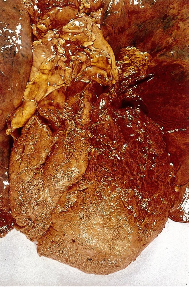 Fibrinous pericarditis in uremia