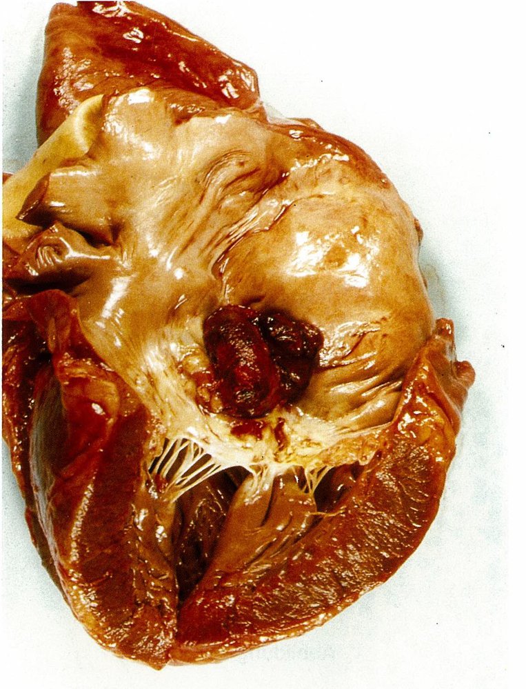 Valve thrombosis in recurrent endocarditis of the mitral valve