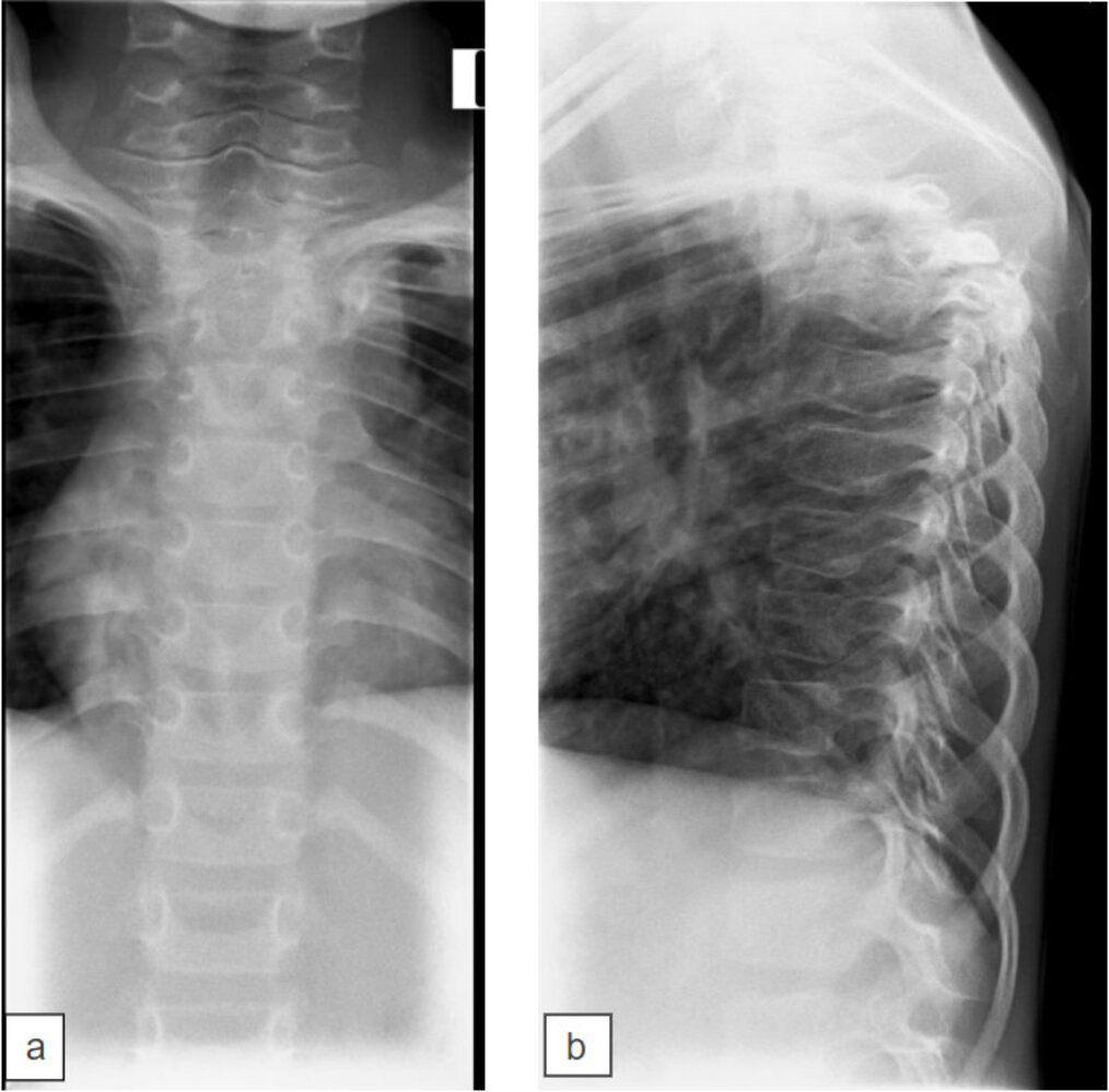 Tuberculous spondylitis (Pott disease) with gibbus deformity