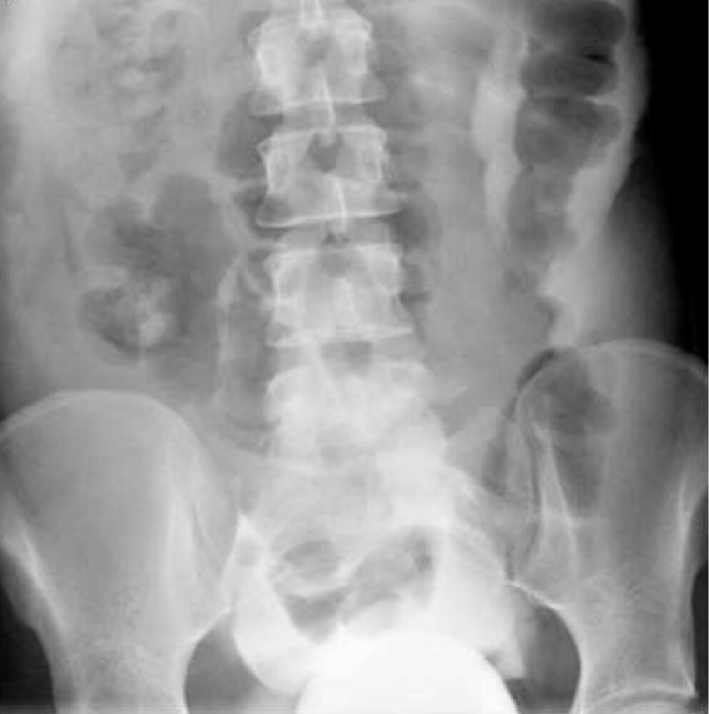 Intraperitoneal bladder rupture