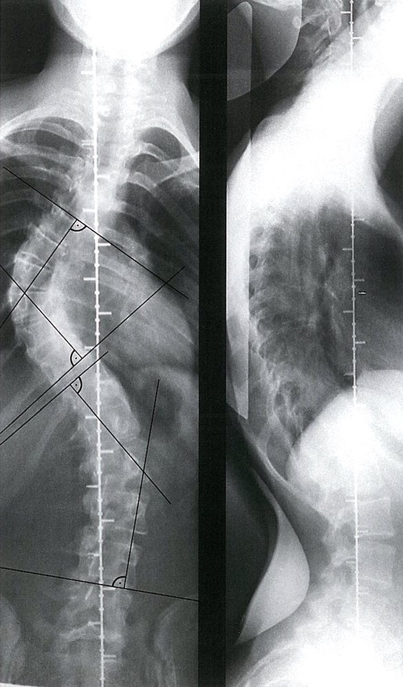 Right convex thoracic scoliosis