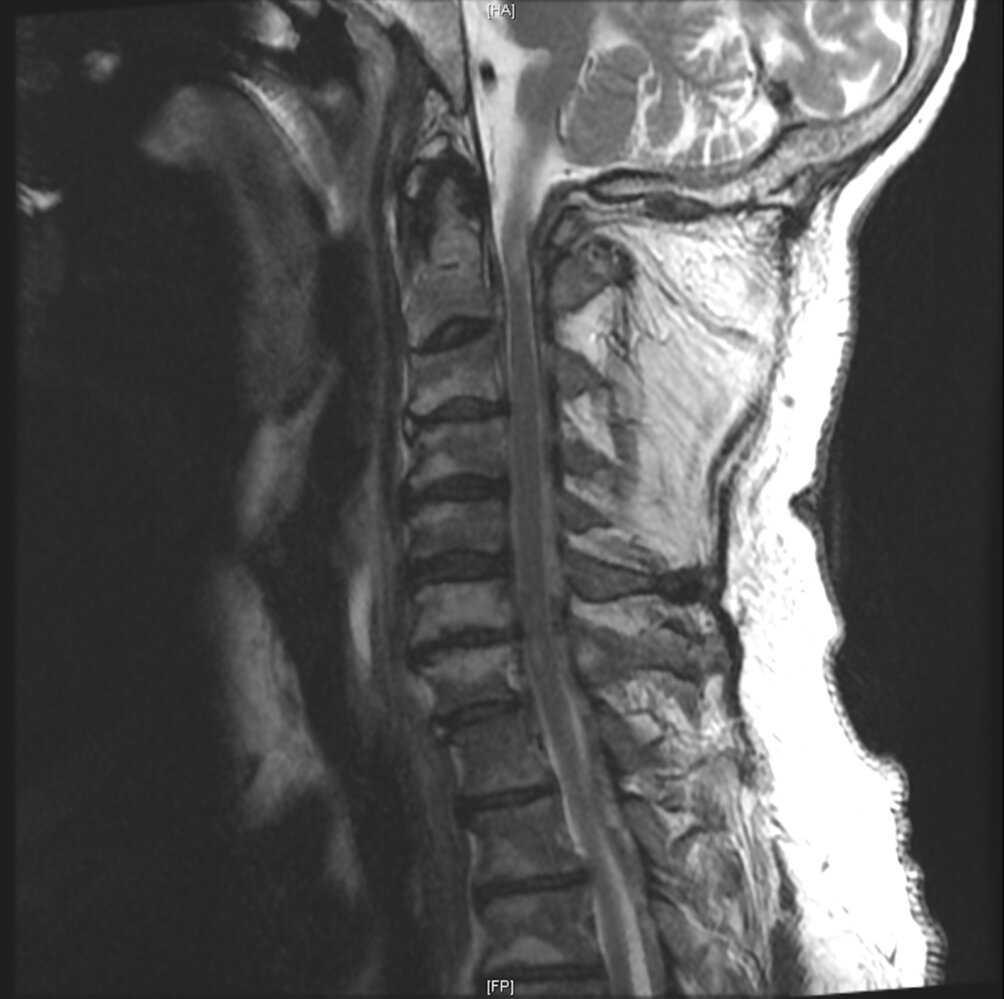 Spinal epidural hematoma
