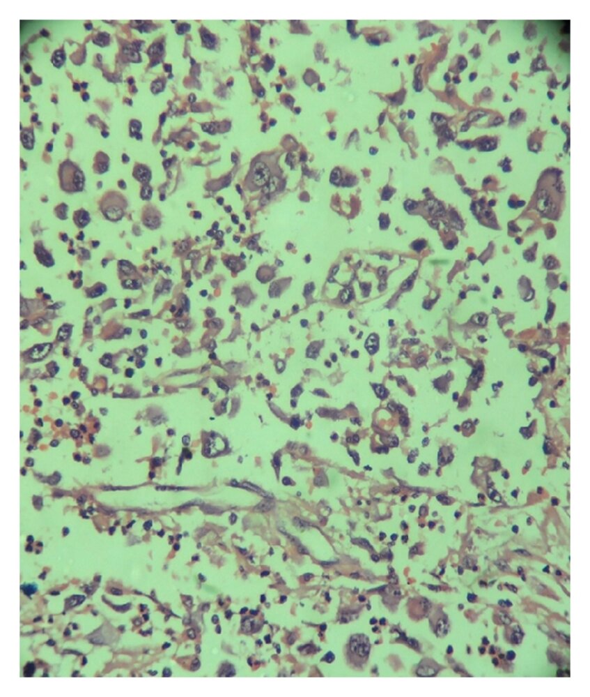 Anaplastic thyroid carcinoma