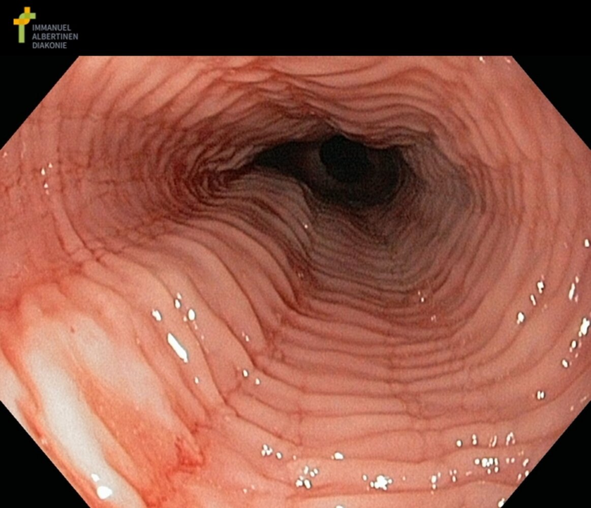 Eosinophilic esophagitis