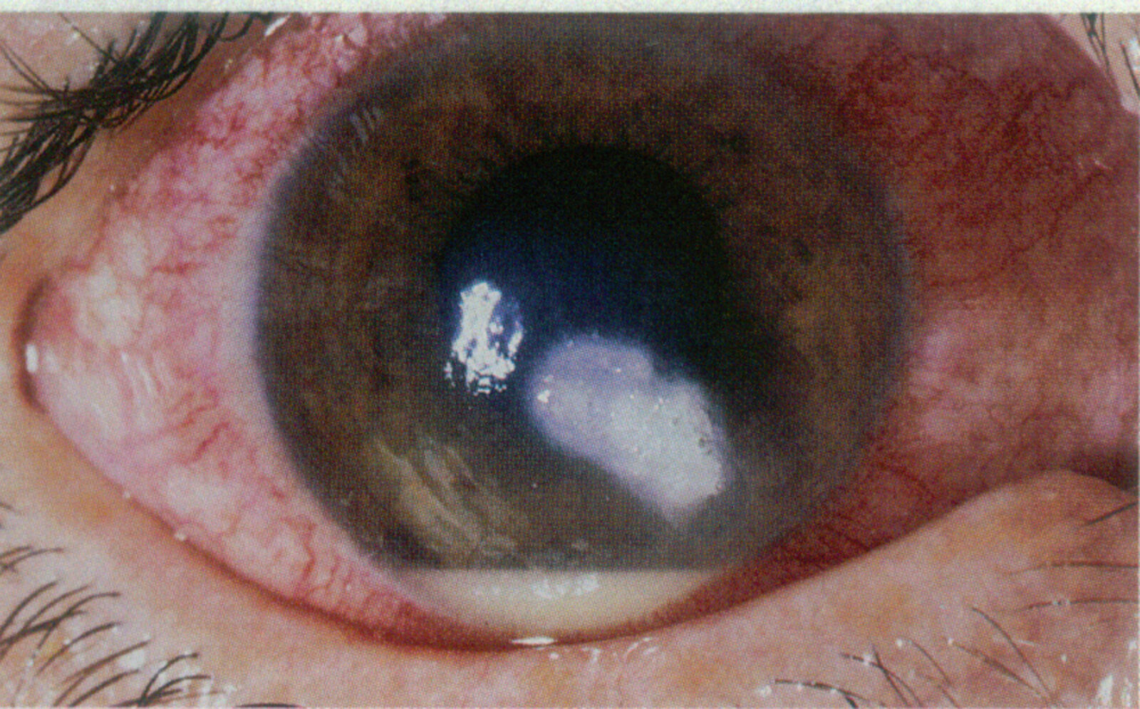 Corneal ulcer
