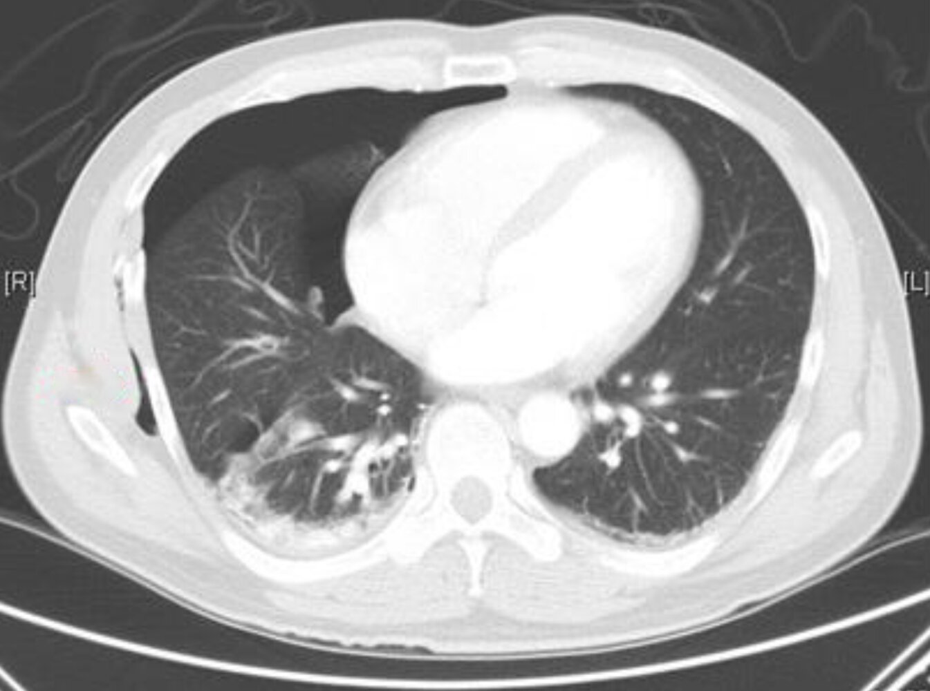 Traumatic pneumothorax and subcutaneous emphysema