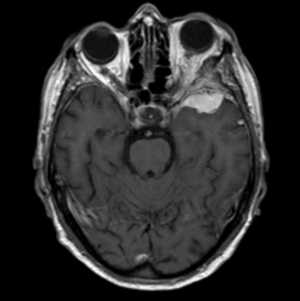 Sphenoid wing meningioma