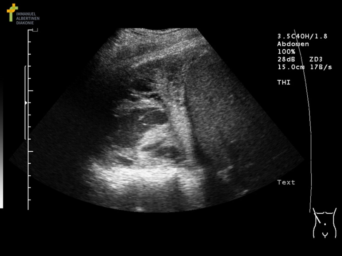 Complex septated pleural collection