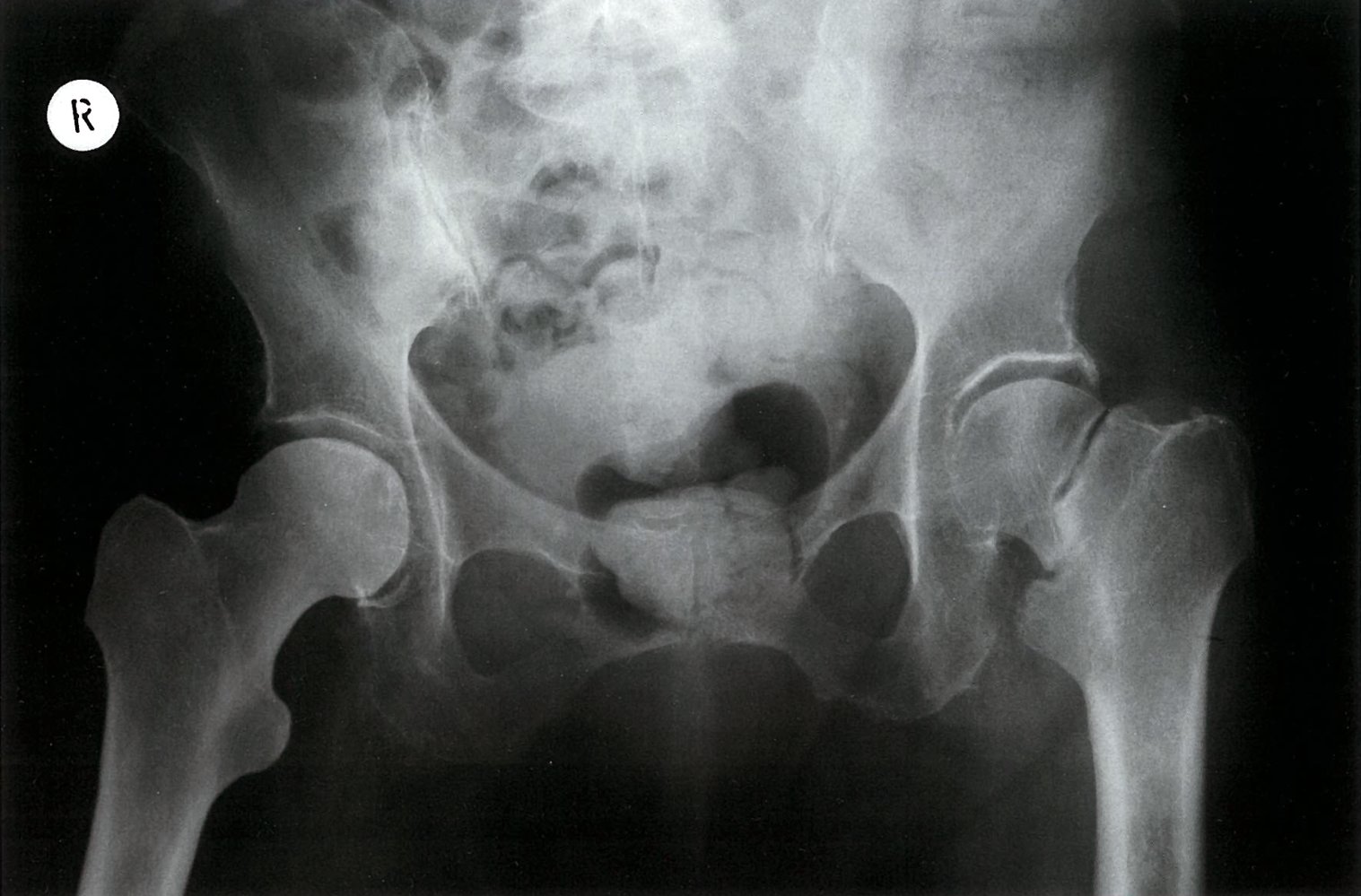 Left femoral neck pseudathrosis