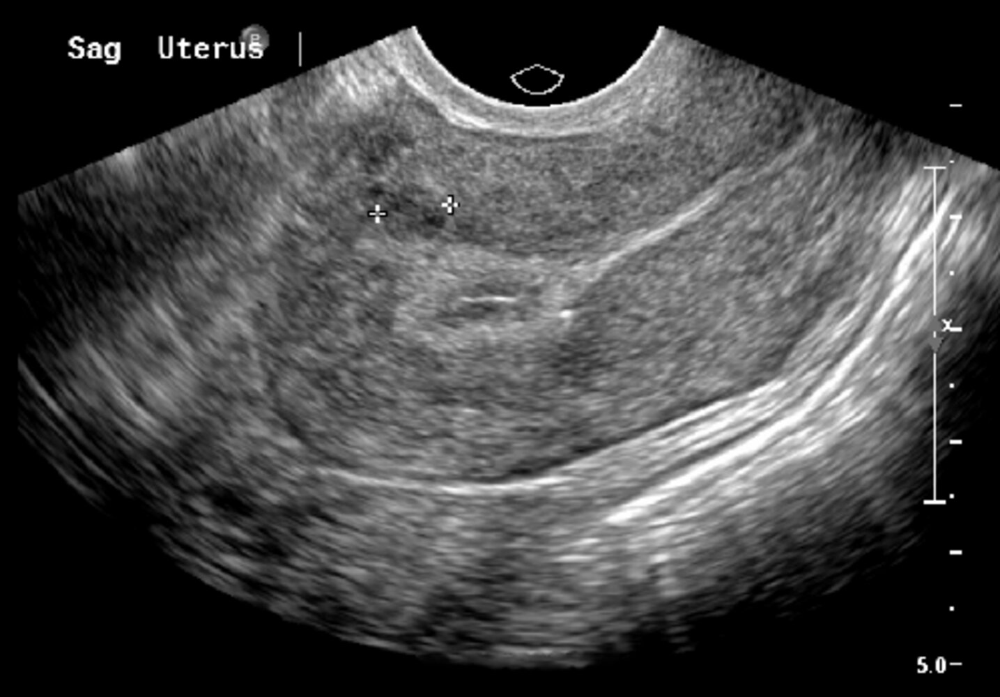 Uterine leiomyoma
