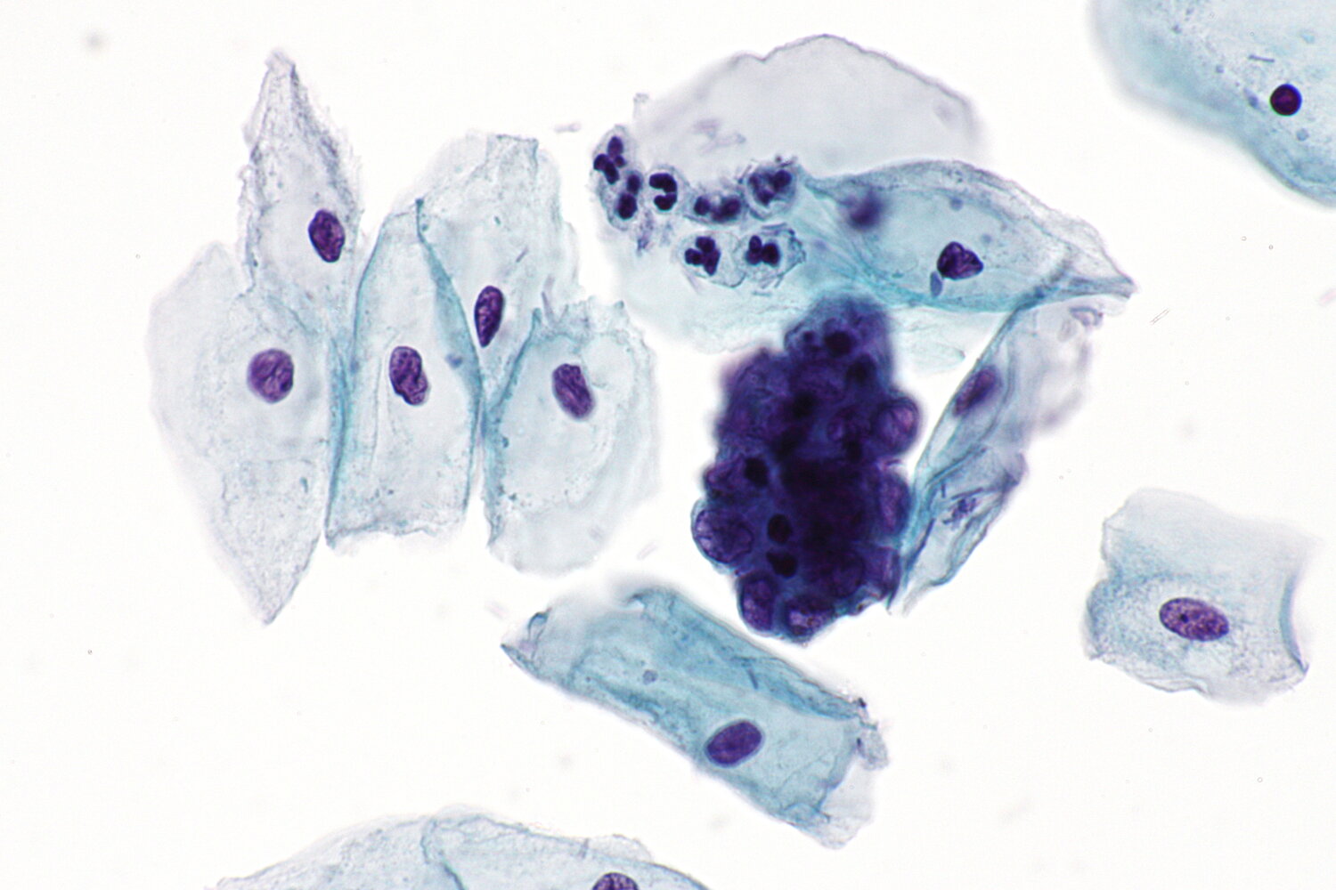 Endometrial cells on Pap smear