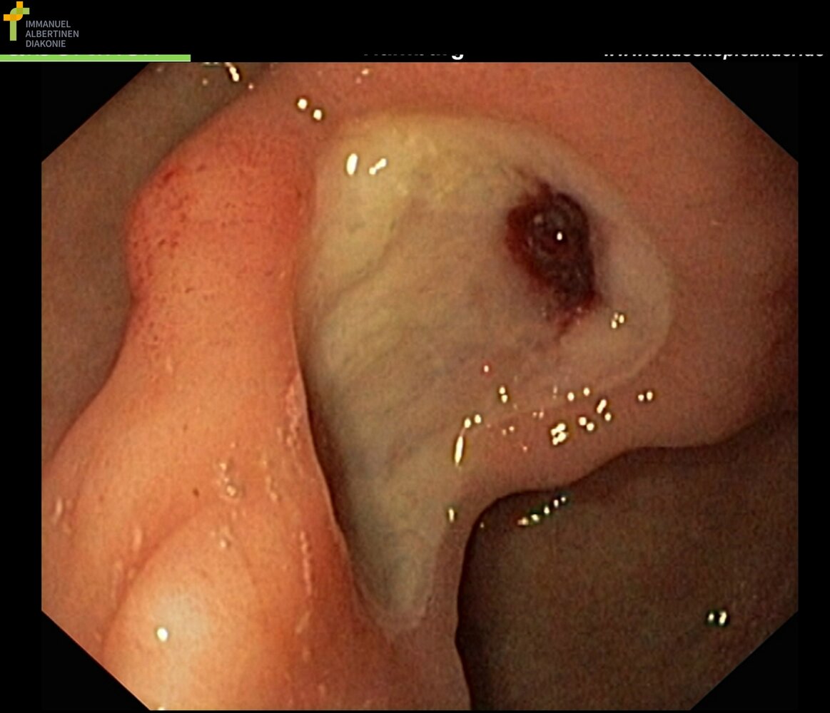 Gastric ulcer: Forrest stage IIa